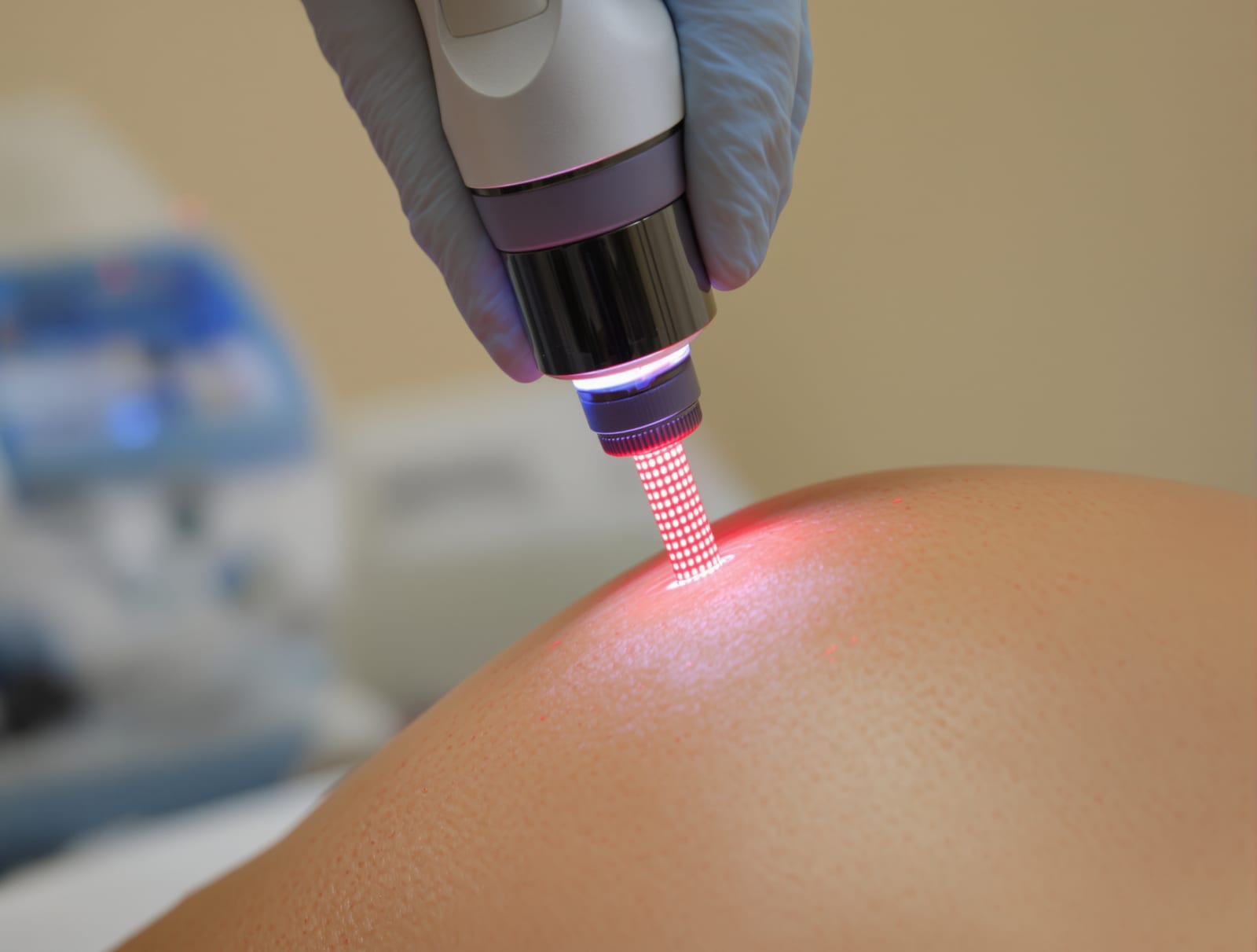 Fractional laser handpiece hovering over skin during treatment