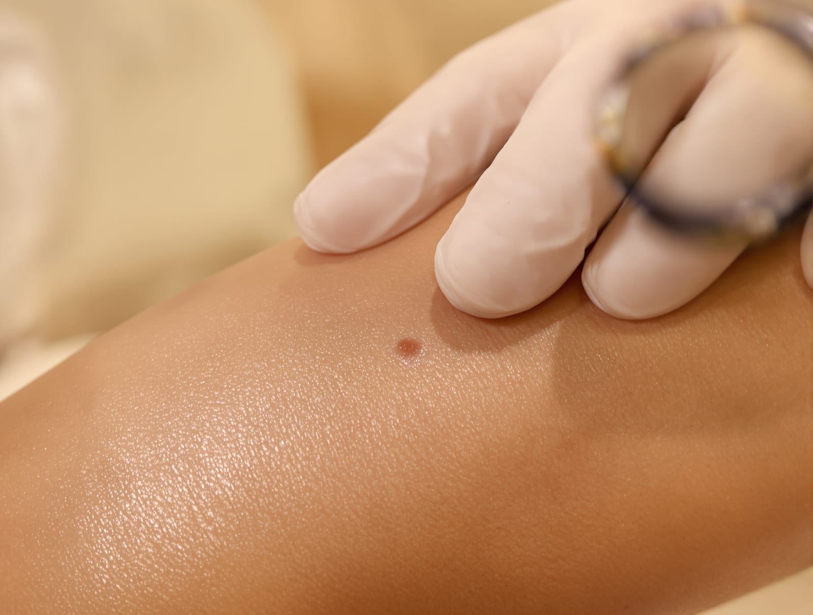 Dermatoscope examining a mole during skin check